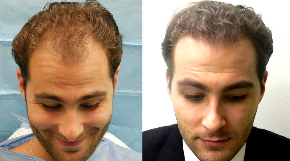 Mollura Medical Hair Restoration | 393 Franklin Ave Suite 105, Franklin Square, NY 11010 | Phone: (516) 354-3876