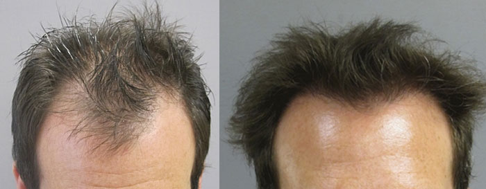 Mollura Medical Hair Restoration | 393 Franklin Ave Suite 105, Franklin Square, NY 11010 | Phone: (516) 354-3876