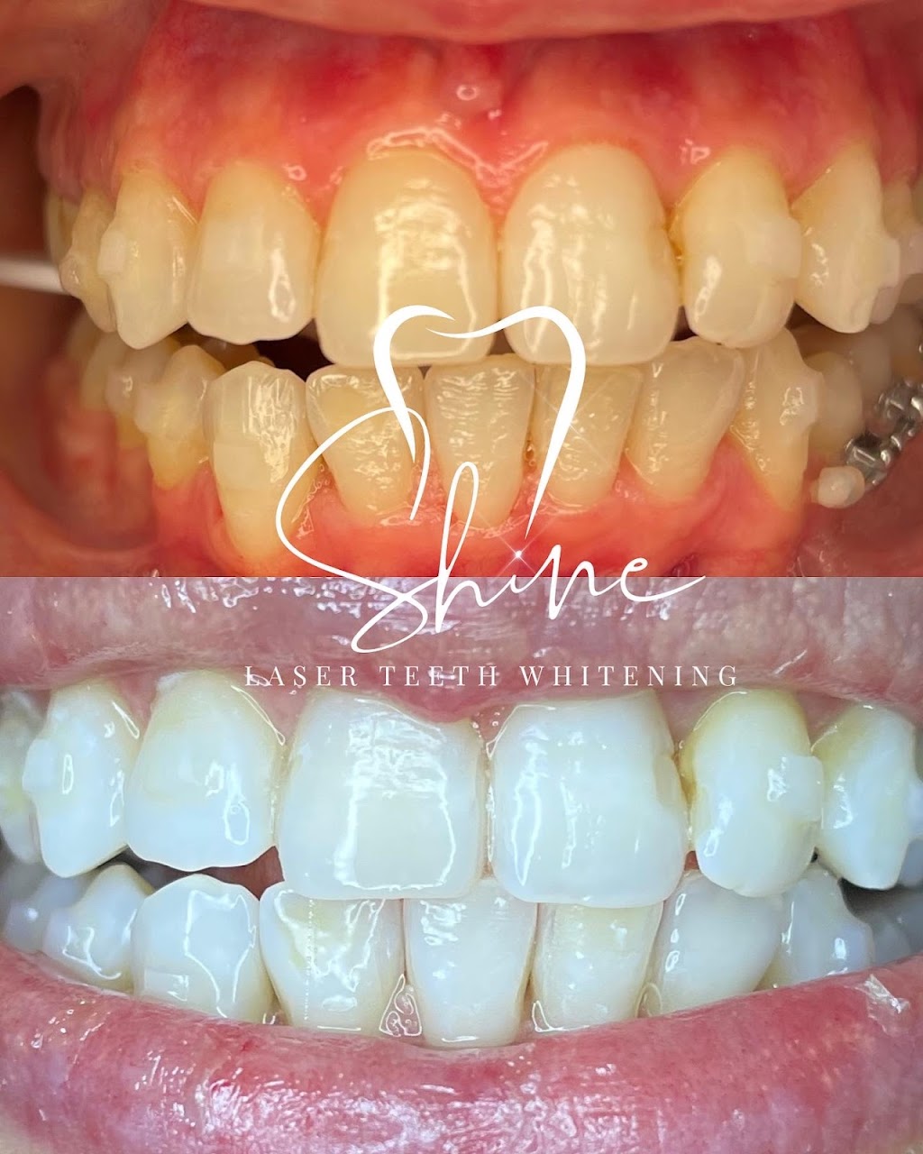 Shine Laser Teeth Whitening Spa | 0 Arnold Ct, East Rockaway, NY 11518 | Phone: (516) 523-9318