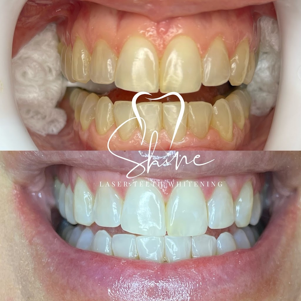 Shine Laser Teeth Whitening Spa | 0 Arnold Ct, East Rockaway, NY 11518 | Phone: (516) 523-9318