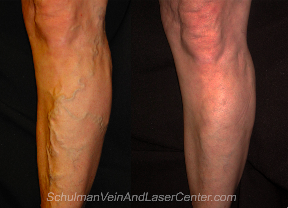 Schulman Vein and Laser Center, Dr. Lee G. Schulman M.D. | 800 Community Dr #211, Manhasset, NY 11030 | Phone: (516) 482-4477