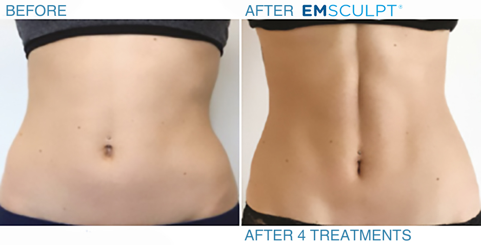 Emsculpt Neo at Skin Westchester | 269 Purchase St, Rye, NY 10580 | Phone: (914) 921-1572