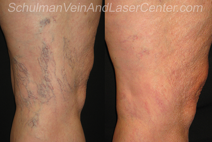 Schulman Vein and Laser Center, Dr. Lee G. Schulman M.D. | 800 Community Dr #211, Manhasset, NY 11030 | Phone: (516) 482-4477