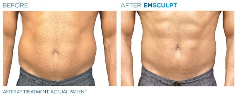 Emsculpt Neo at Skin Westchester | 269 Purchase St, Rye, NY 10580 | Phone: (914) 921-1572